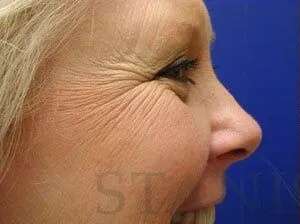 Botox Dysport Before & After Patient #156