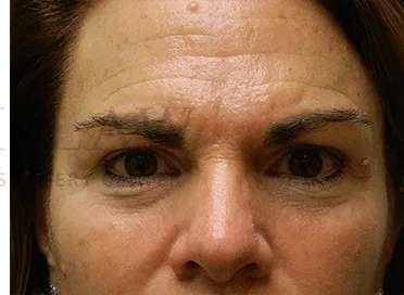 Botox Dysport Before & After Patient #164