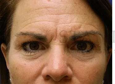 Botox Dysport Before & After Patient #164