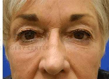 Botox Dysport Before & After Patient #167