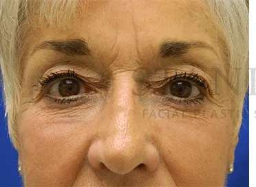 Botox Dysport Before & After Patient #167