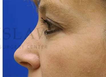 Botox Dysport Before & After Patient #161