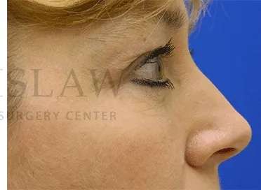 Botox Dysport Before & After Patient #161
