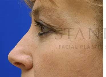 Botox Dysport Before & After Patient #161
