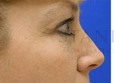 Botox Dysport Before & After Patient #161