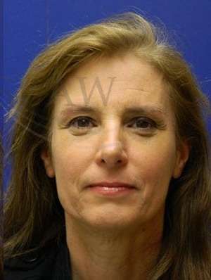 Browlift Before & After Patient #183
