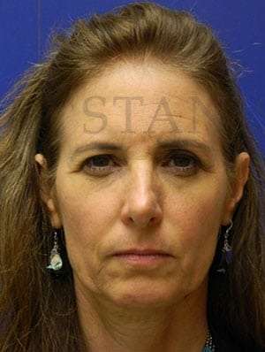 Browlift Before & After Patient #183
