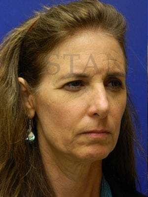 Browlift Before & After Patient #183