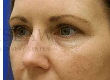 Botox Dysport Before & After Patient #172