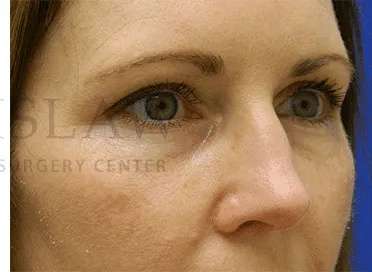 Botox Dysport Before & After Patient #172