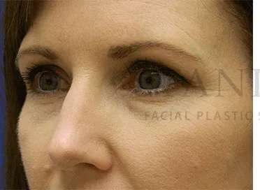 Botox Dysport Before & After Patient #172