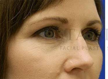 Botox Dysport Before & After Patient #172