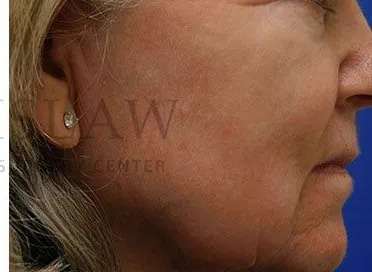 Chemical Peel Before & After Patient #202