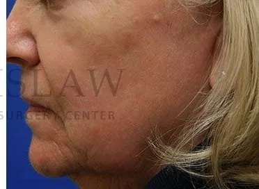 Chemical Peel Before & After Patient #202