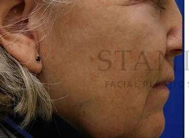 Chemical Peel Before & After Patient #202
