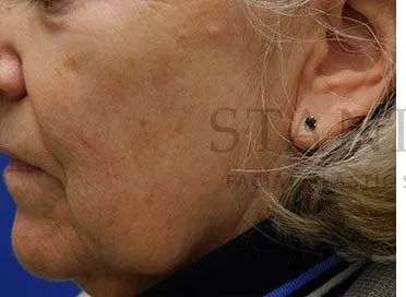 Chemical Peel Before & After Patient #202