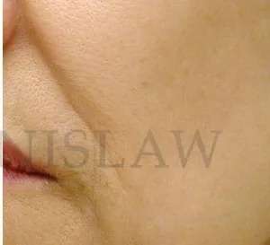 Chemical Peel Before & After Patient #231