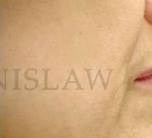 Chemical Peel Before & After Patient #231