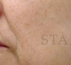 Chemical Peel Before & After Patient #231