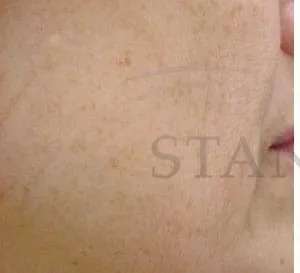 Chemical Peel Before & After Patient #231