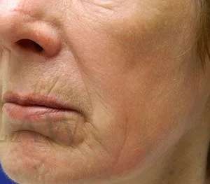 Chemical Peel Before & After Patient #242