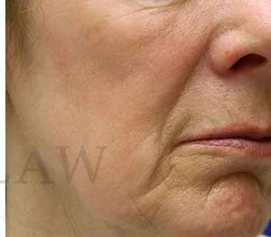 Chemical Peel Before & After Patient #242