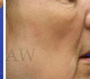 Chemical Peel Before & After Patient #242