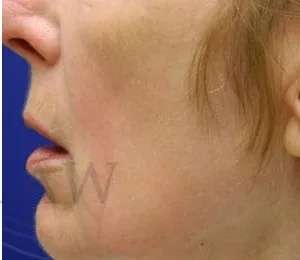 Chemical Peel Before & After Patient #242