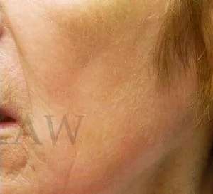 Chemical Peel Before & After Patient #242