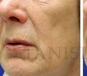 Chemical Peel Before & After Patient #242