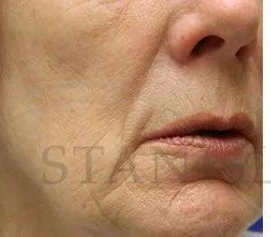 Chemical Peel Before & After Patient #242