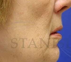 Chemical Peel Before & After Patient #242