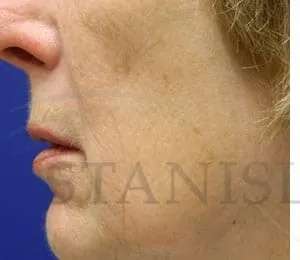 Chemical Peel Before & After Patient #242