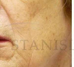Chemical Peel Before & After Patient #242