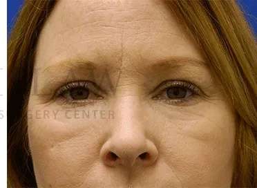 Chemical Peel Before & After Patient #226