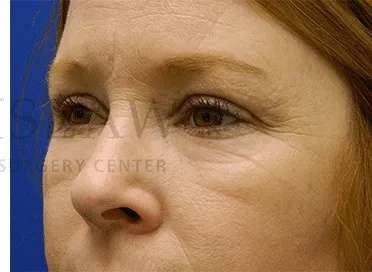 Chemical Peel Before & After Patient #226