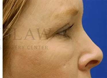 Chemical Peel Before & After Patient #226