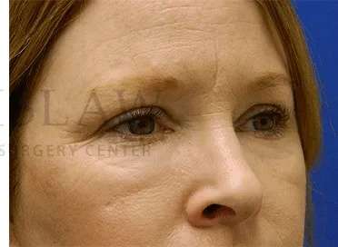 Chemical Peel Before & After Patient #226
