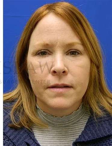 Chemical Peel Before & After Patient #226