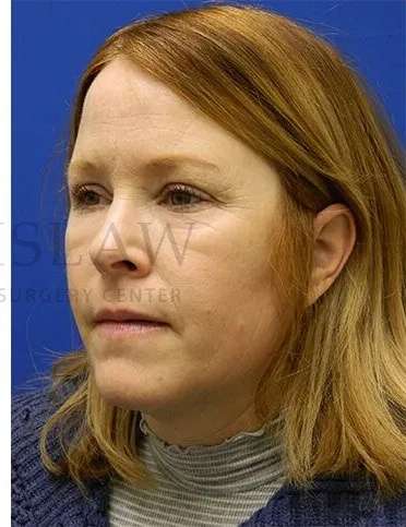 Chemical Peel Before & After Patient #226