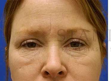 Chemical Peel Before & After Patient #226