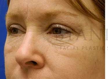 Chemical Peel Before & After Patient #226