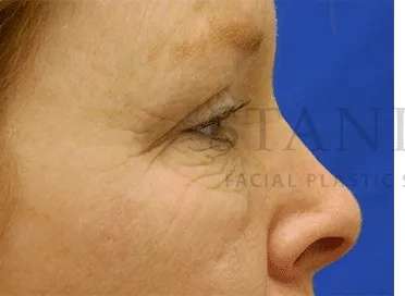 Chemical Peel Before & After Patient #226