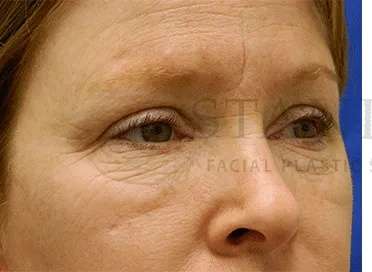 Chemical Peel Before & After Patient #226