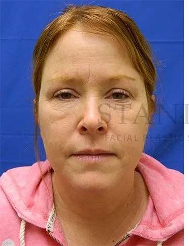 Chemical Peel Before & After Patient #226