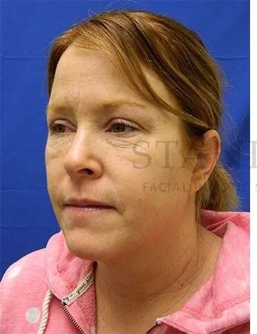 Chemical Peel Before & After Patient #226