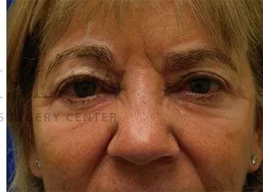 Chemical Peel Before & After Patient #213