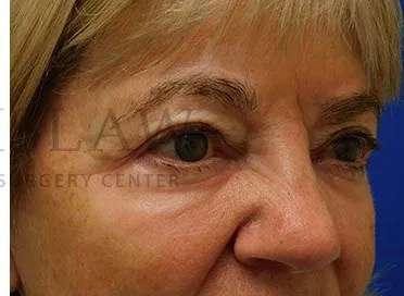 Chemical Peel Before & After Patient #213