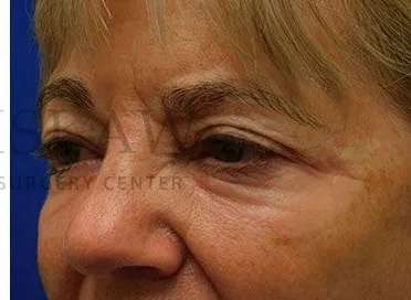 Chemical Peel Before & After Patient #213
