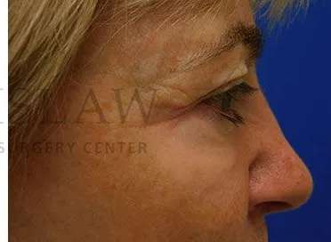 Chemical Peel Before & After Patient #213
